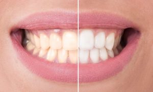 Cosmetic dentistry | Prime Dental Associates