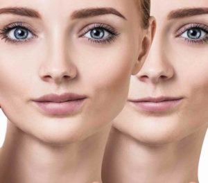 Juvederm Johnsburg | Prime Dental Associates